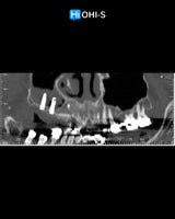 Predictable Sinus Lift