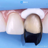 The Biomimetic Concept: Composite Restoration Protocols