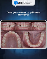 Missing Maxillary Lateral Incisors: Space Closure in All Malocclusions vs. Implants and Prosthetic Replacement