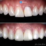 The Biomimetic Concept: Composite Restoration Protocols