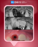 Soft Tissue Plastic Surgery around Implants