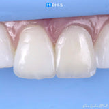 The Biomimetic Concept: Composite Restoration Protocols