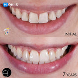 Composite Veneers, All Restorative Techniques
