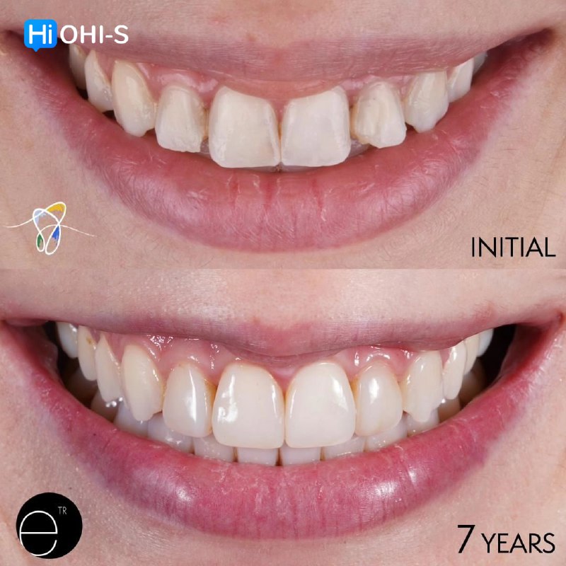 Composite Veneers, All Restorative Techniques
