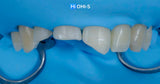 International Schools Working with Composite Restorations