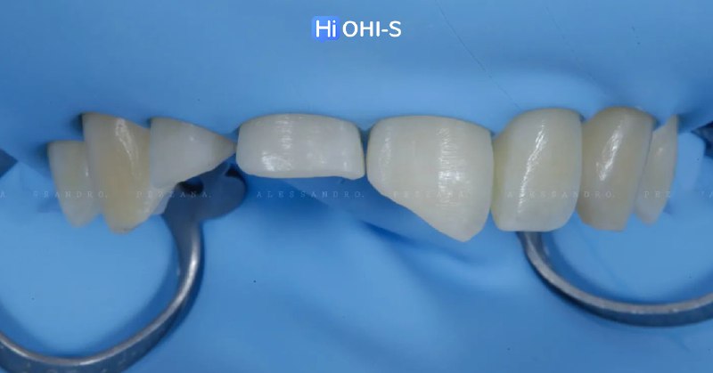 International Schools Working with Composite Restorations