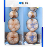 International Schools Working with Composite Restorations