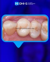 The Biomimetic Concept: Composite Restoration Protocols