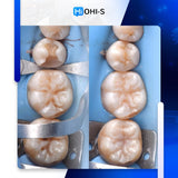 International Schools Working with Composite Restorations
