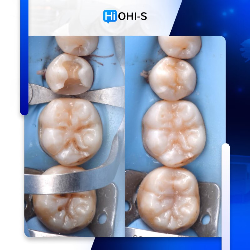 International Schools Working with Composite Restorations