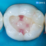 International Schools Working with Composite Restorations