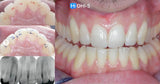 International Schools Working with Composite Restorations