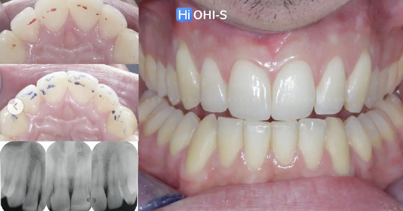International Schools Working with Composite Restorations
