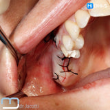 Predictable Sinus Lift