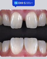 International Schools Working with Composite Restorations