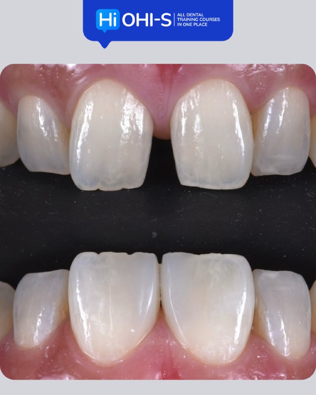 International Schools Working with Composite Restorations
