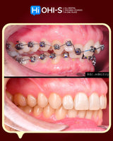 Damon 2.0. How to treat all common malocclusions