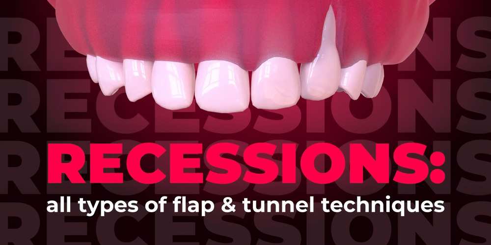 Recessions: all types of flap & tunnel techniques