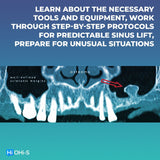 Predictable Sinus Lift
