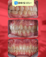 Aligners and Microimplants: Combined Protocol