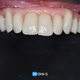 Removable dentures for dentists and technicians