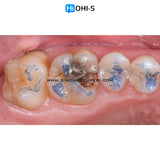 The Biomimetic Concept: Composite Restoration Protocols