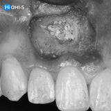 Apical Surgery: For Endodontists and Surgeons