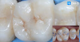 International Schools Working with Composite Restorations