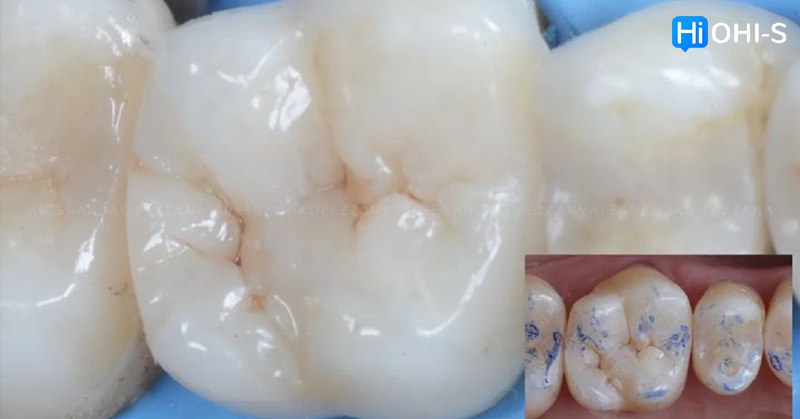 International Schools Working with Composite Restorations