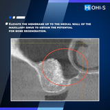Predictable Sinus Lift