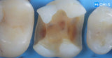 International Schools Working with Composite Restorations