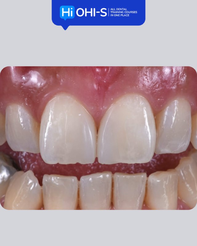 International Schools Working with Composite Restorations