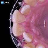 Damon 2.0. How to treat all common malocclusions