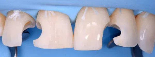 Direct and Indirect Adhesive Restorations - Dental Courses | كورسات طب اسنان