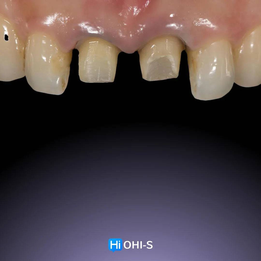 Ceramic Layering: Protocols of the World’s Leading Schools - Dental Courses | كورسات طب اسنان