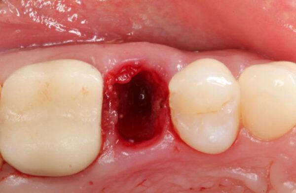 Extraction Socket – Preservation/Grafting; Immediate vs Delayed Implants; Pontic Site Development - Dental Courses | كورسات طب اسنان