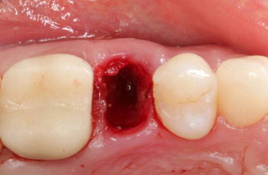 Extraction Socket – Preservation/Grafting; Immediate vs Delayed Implants; Pontic Site Development - Dental Courses | كورسات طب اسنان