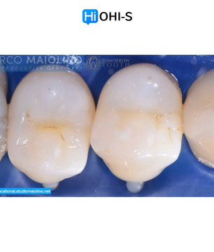 Bioclear Dental Restoration - Dental Courses | كورسات طب اسنان