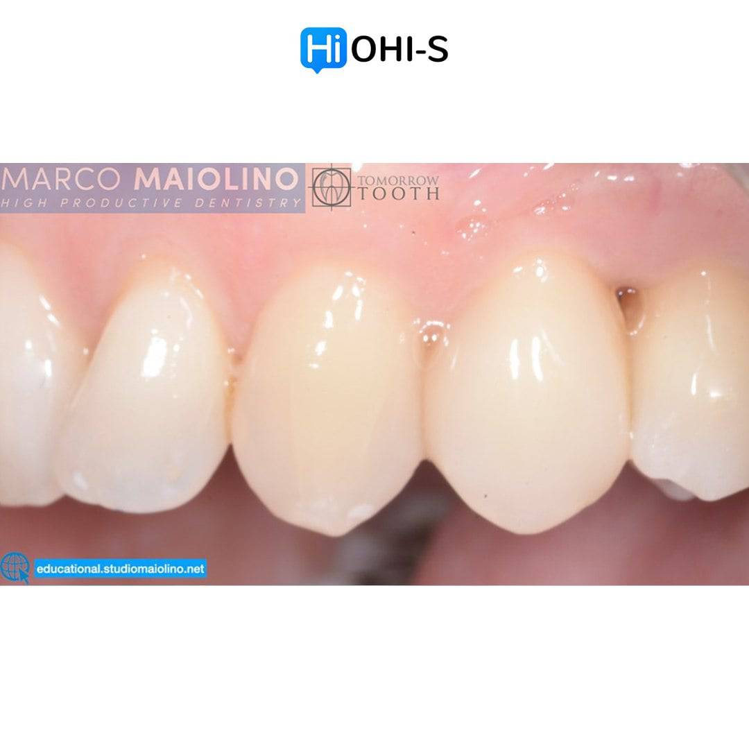 Bioclear Dental Restoration - Dental Courses | كورسات طب اسنان