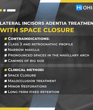 Missing Maxillary Lateral Incisors: Space Closure in all Malocclusions vs Implants and Prosthetic Replacement - Dental Courses | كورسات طب اسنان