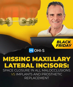 Missing Maxillary Lateral Incisors: Space Closure in all Malocclusions vs Implants and Prosthetic Replacement - Dental Courses | كورسات طب اسنان