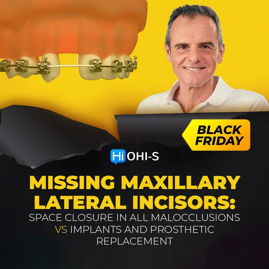 Missing Maxillary Lateral Incisors: Space Closure in all Malocclusions vs Implants and Prosthetic Replacement - Dental Courses | كورسات طب اسنان