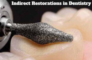 Indirect Restorations in Dentistry – A Complete Guide - Dental Courses | كورسات طب اسنان