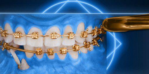 OHI-S Impaction Treatment Author’s Protocols, Mistakes and Solutions - Dental Courses | كورسات طب اسنان