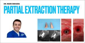 Partial Extraction Therapy Course - Dental Courses | كورسات طب اسنان