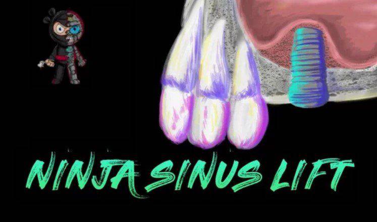 Ninja Sinus Lift Course - Dental Courses | كورسات طب اسنان