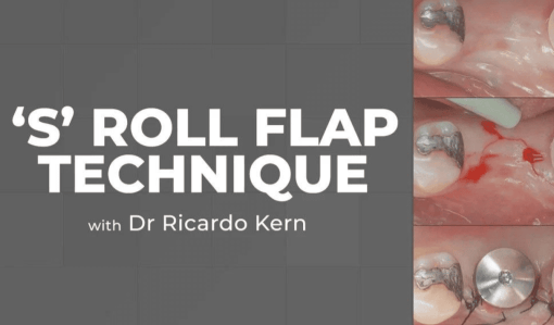 The S Roll Flap Technique - Dental Courses | كورسات طب اسنان