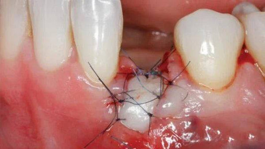 Soft Tissue Management around Natural Teeth and Dental Implants - Dental Courses | كورسات طب اسنان