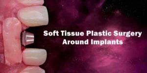 Soft Tissue Plastic Surgery Around Implants - Dental Courses | كورسات طب اسنان