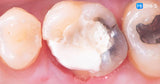 All‑Digital Workflow: Protocols for Flawless Indirect Restorations